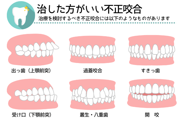 不正咬合の種類