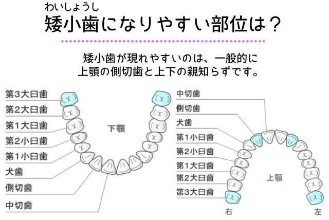 矮小歯になりやすい部位