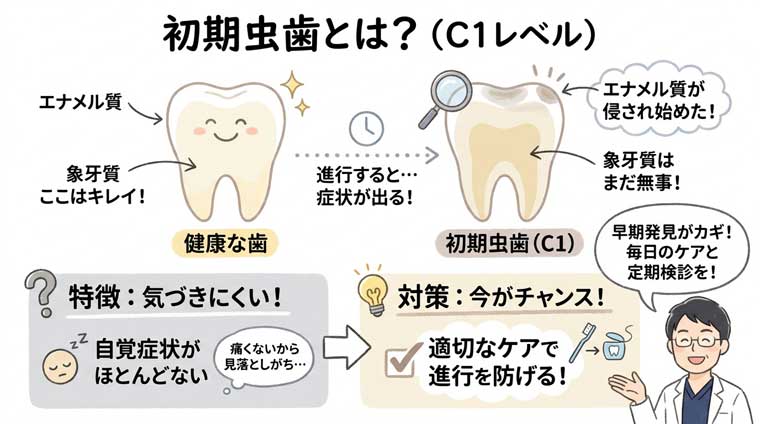初期虫歯とは？の図解