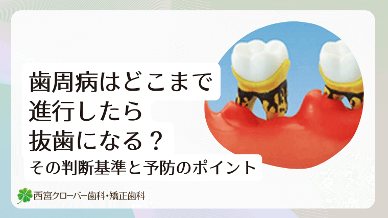 歯周病はどこまで進行したら抜歯になる?