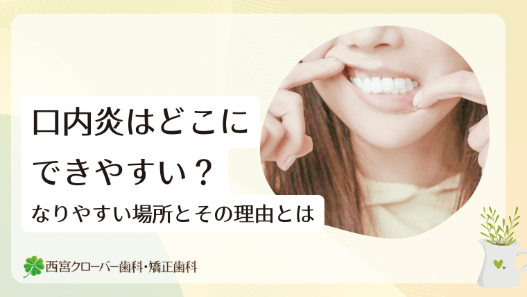 口内炎はどこにできやすい?なりやすい場所とその理由とは