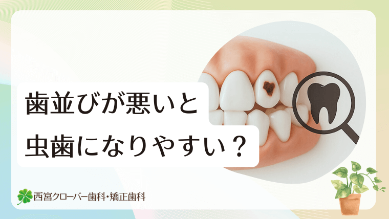 歯並びが悪いと虫歯になりやすい？