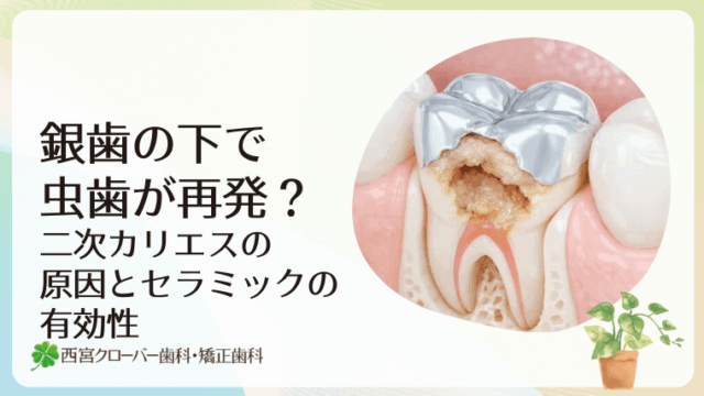 銀歯の下で虫歯が再発？二次カリエスの原因とセラミックの有効性