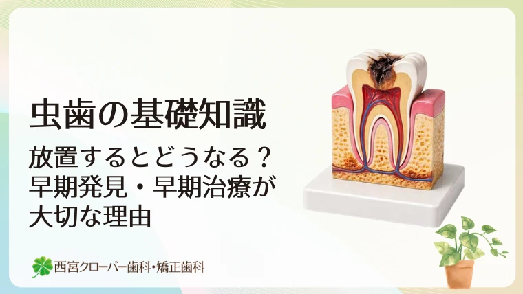 虫歯の基礎知識｜放置するとどうなる？早期発見・早期治療が大切な理由