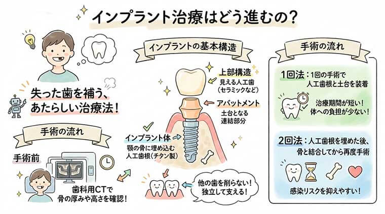 インプラント治療はどう進むの？の図解