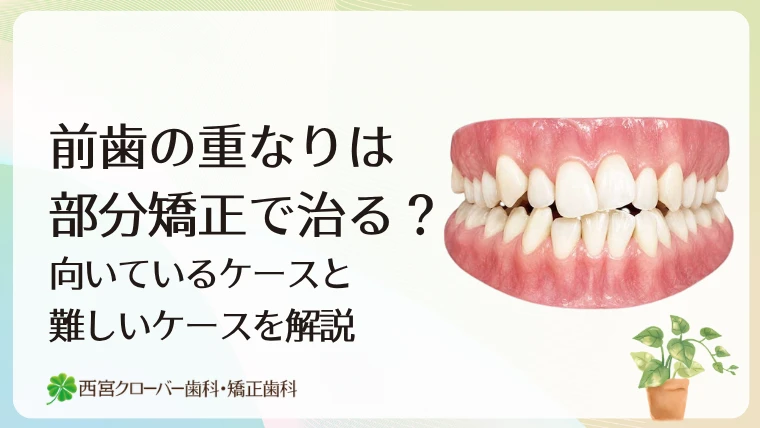 前歯の重なりは部分矯正で治る？向いているケースと難しいケースを解説