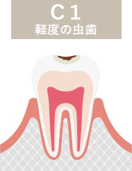 虫歯：c1