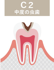 虫歯：c2