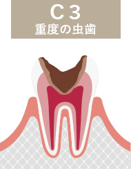 虫歯：c3