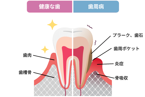 健康な歯と歯周病の比較